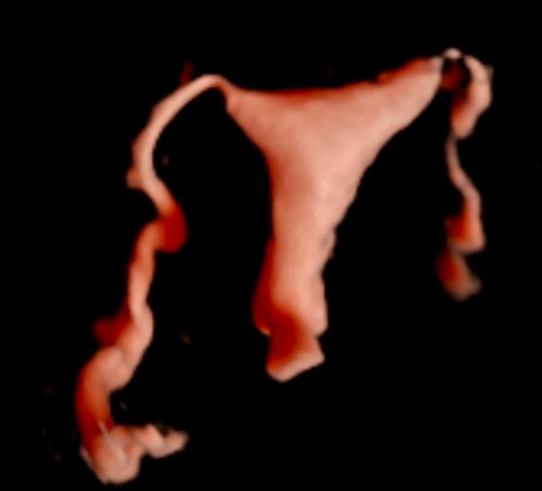 Endometriose e Hycosy na Clínica Ló em Sorriso, MT — Mapeamento de endometriose e avaliação da permeabilidade das trompas por ultrassom.